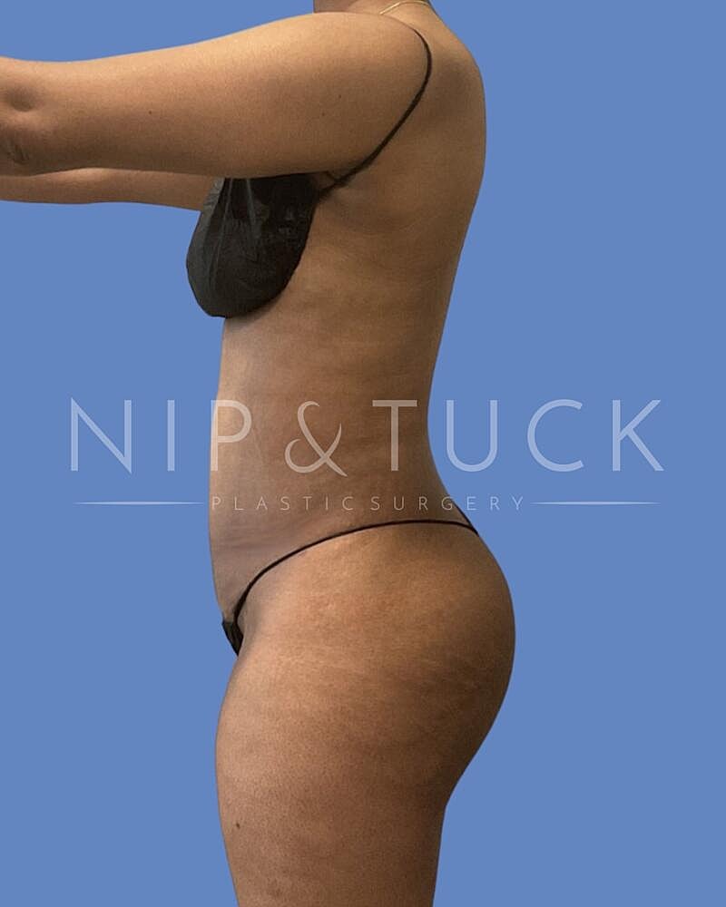 Abdominoplasty Before & After