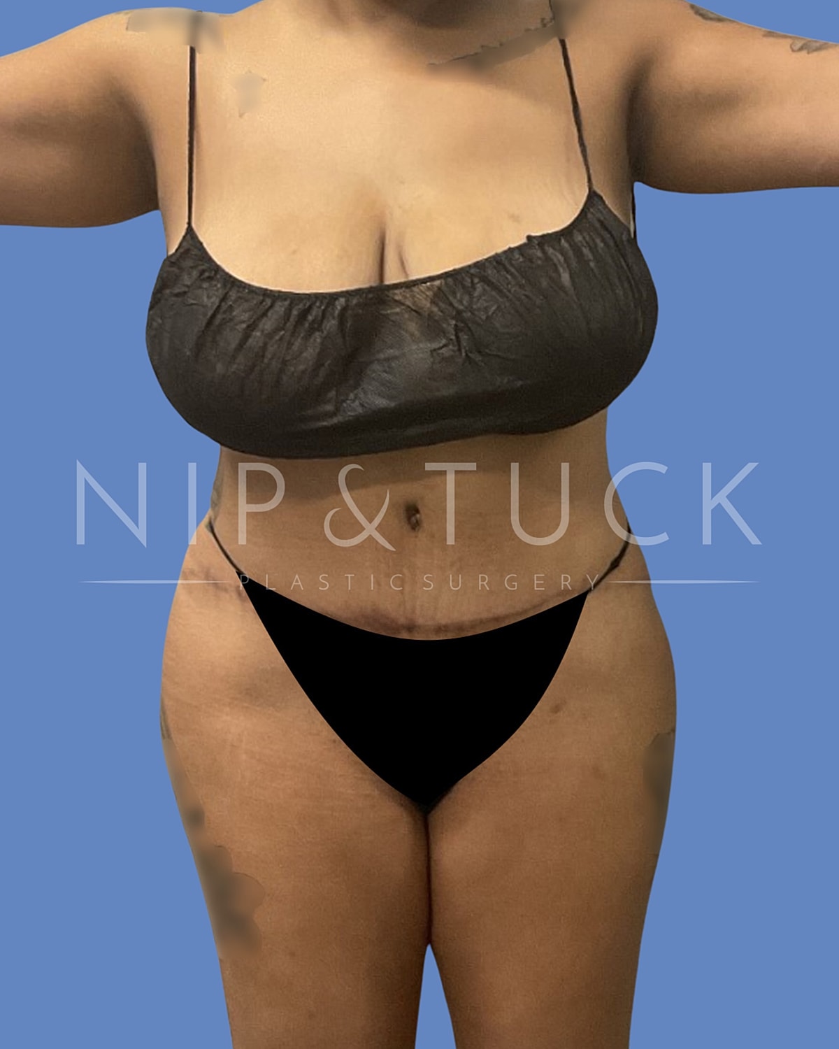 Abdominoplasty Before & After