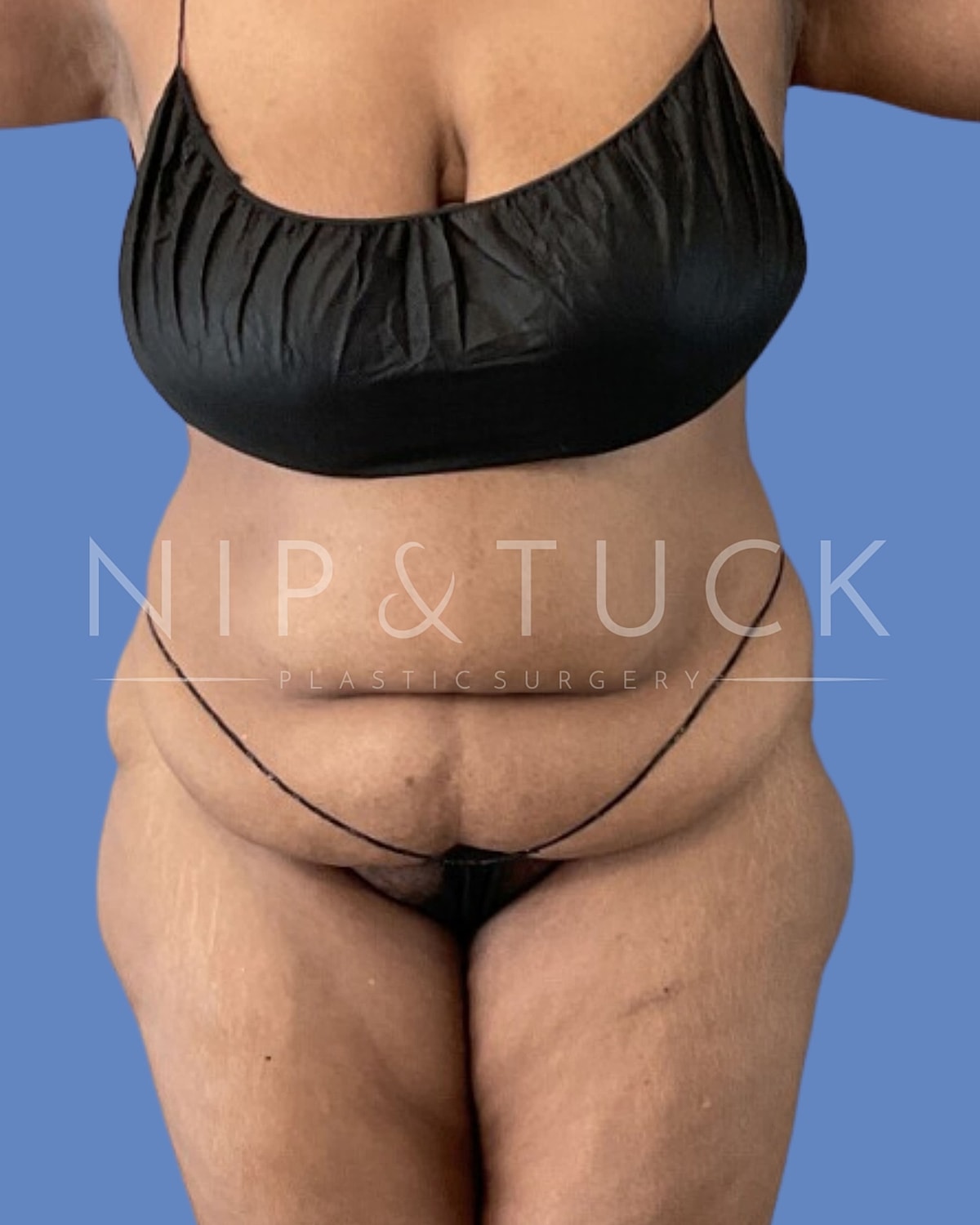 Abdominoplasty Before & After