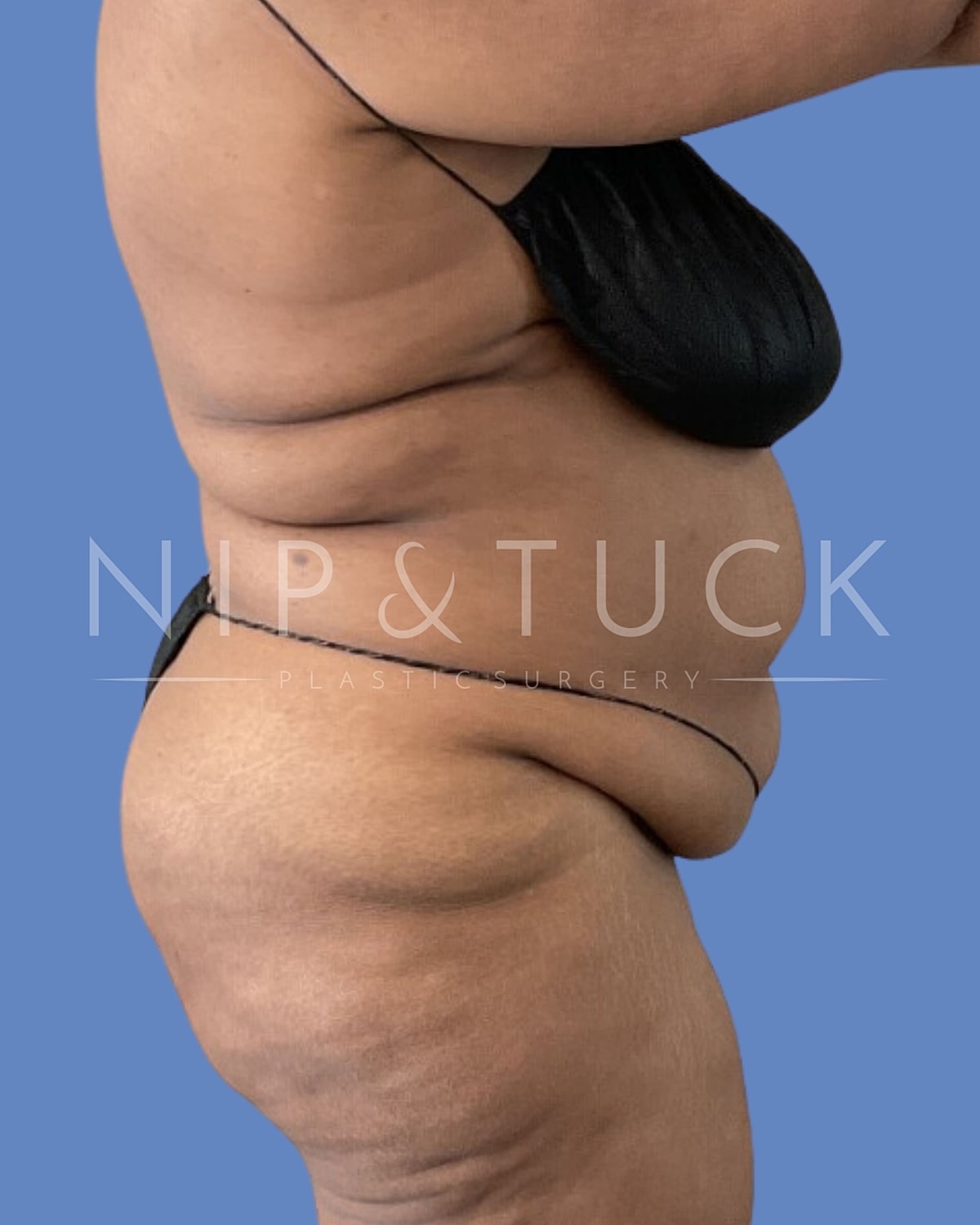 Abdominoplasty Before & After