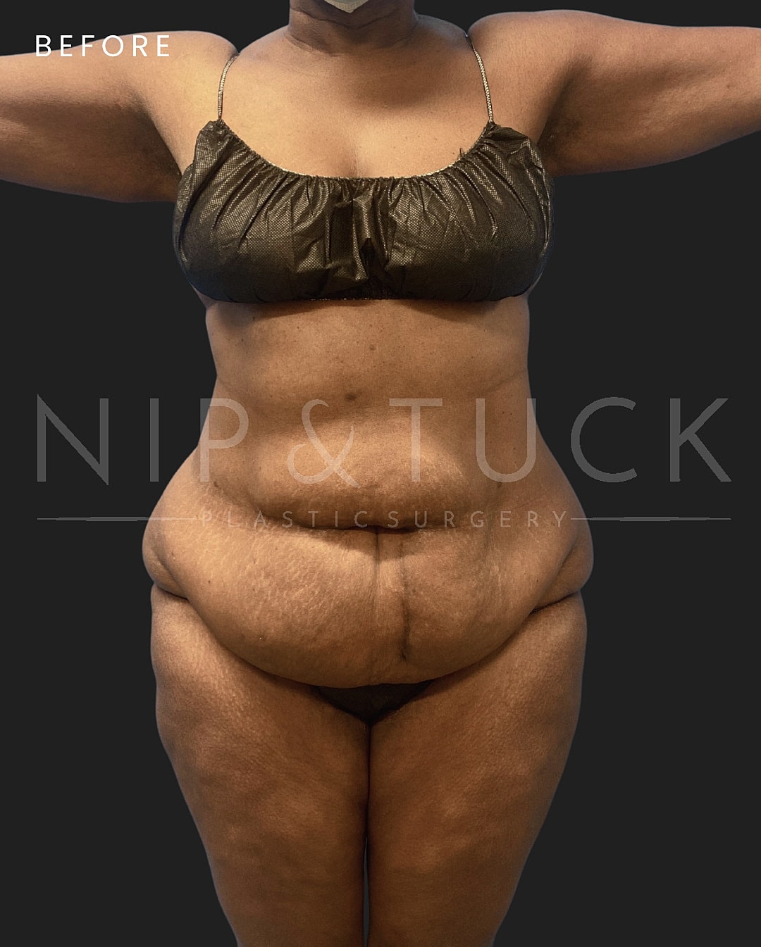 Abdominoplasty Before & After
