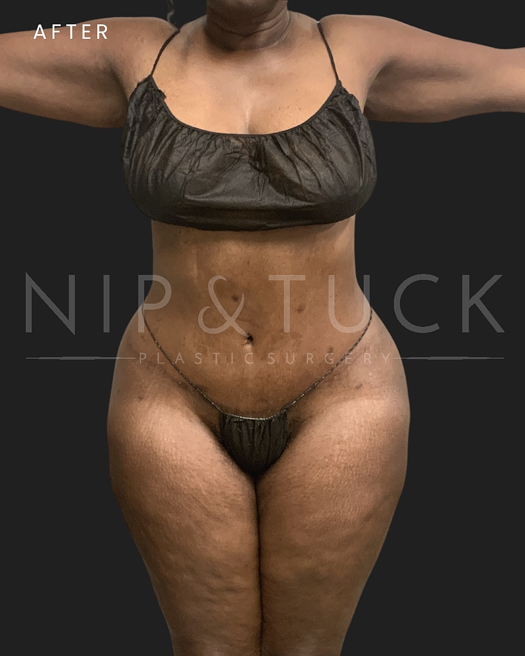 Abdominoplasty Before & After