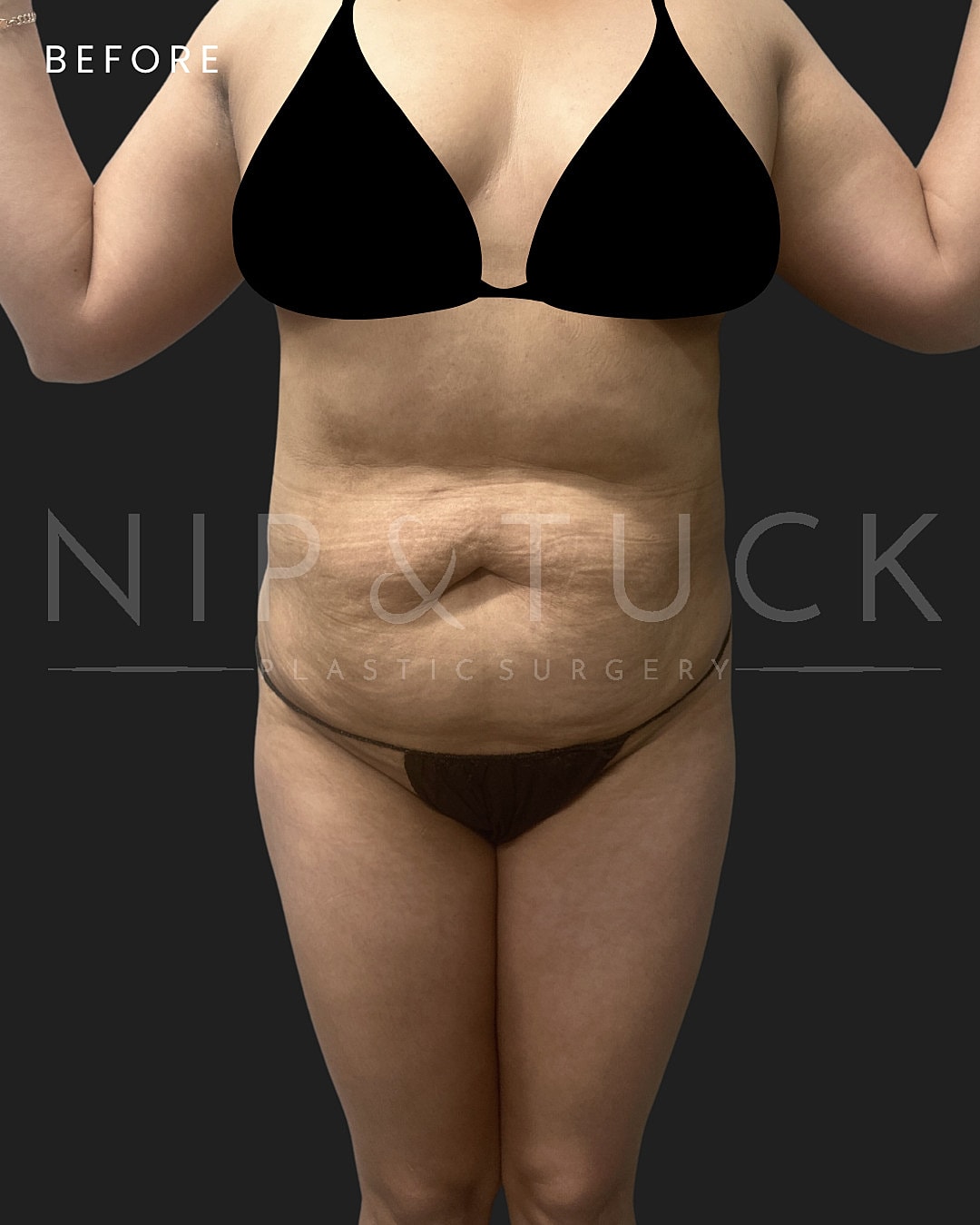 Abdominoplasty Before & After