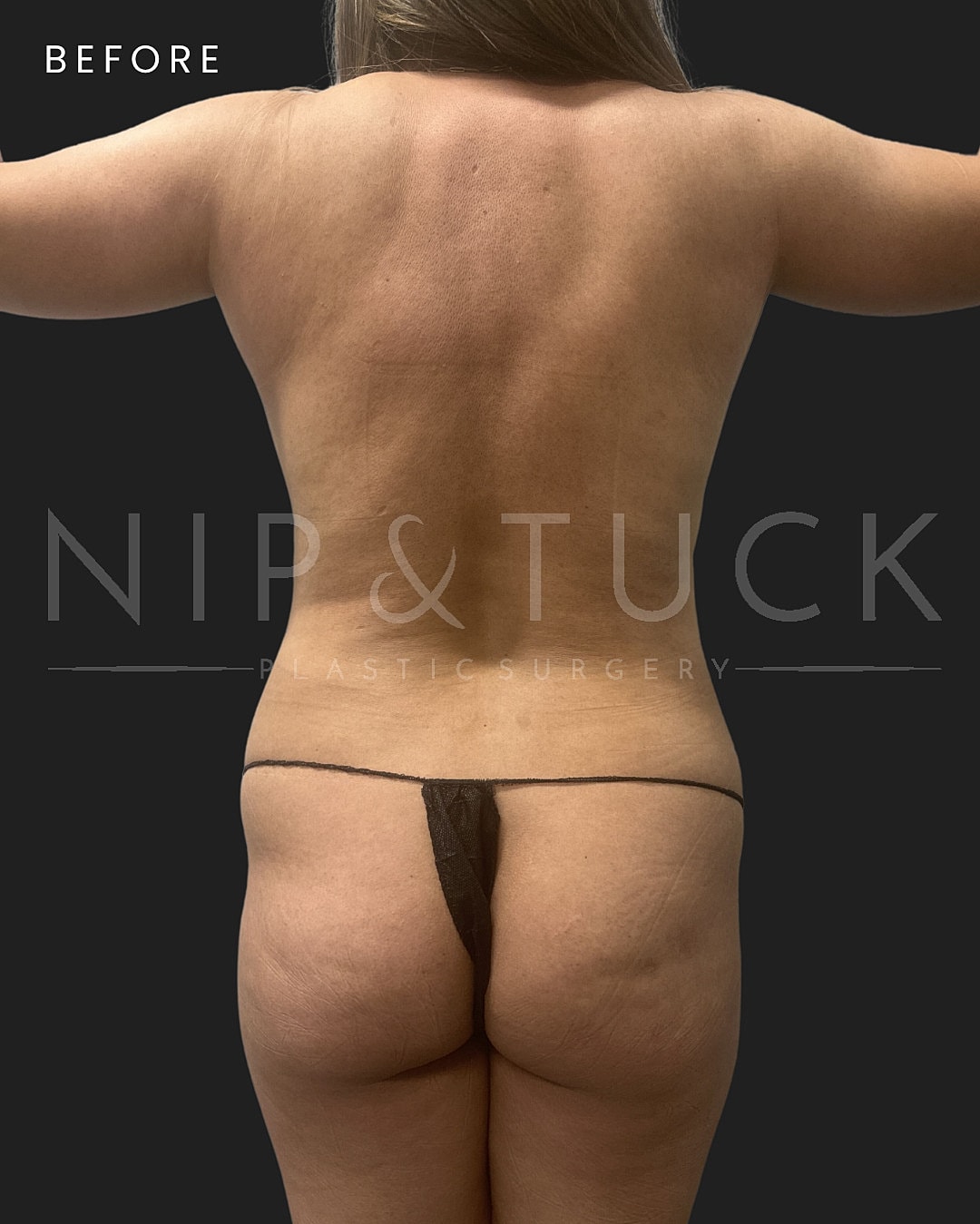 Abdominoplasty Before & After