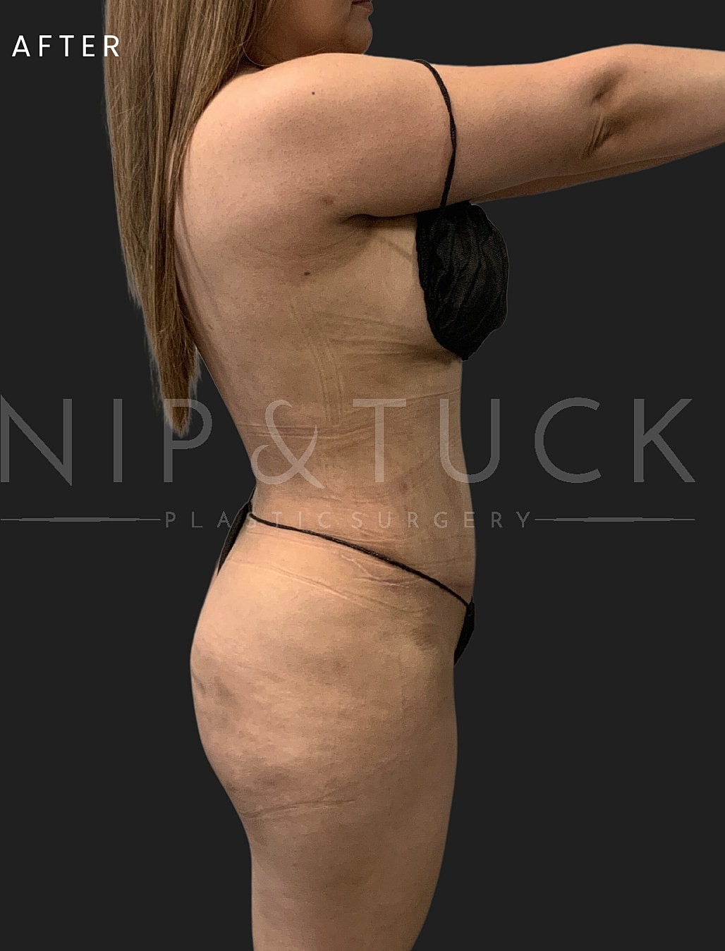 Abdominoplasty Before & After