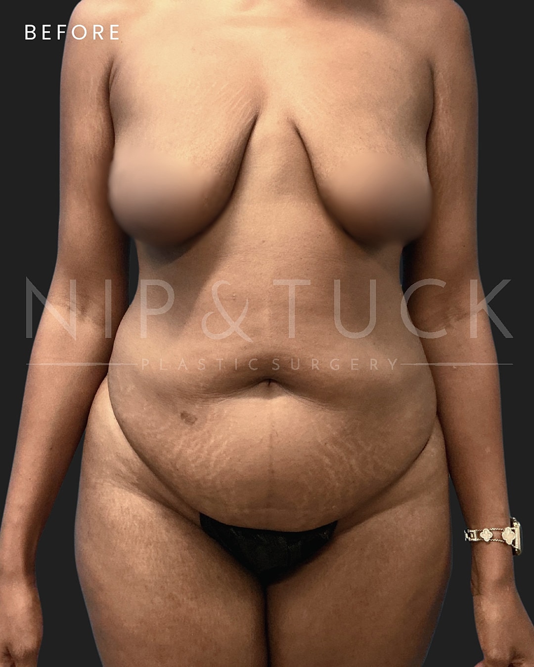Abdominoplasty Before & After
