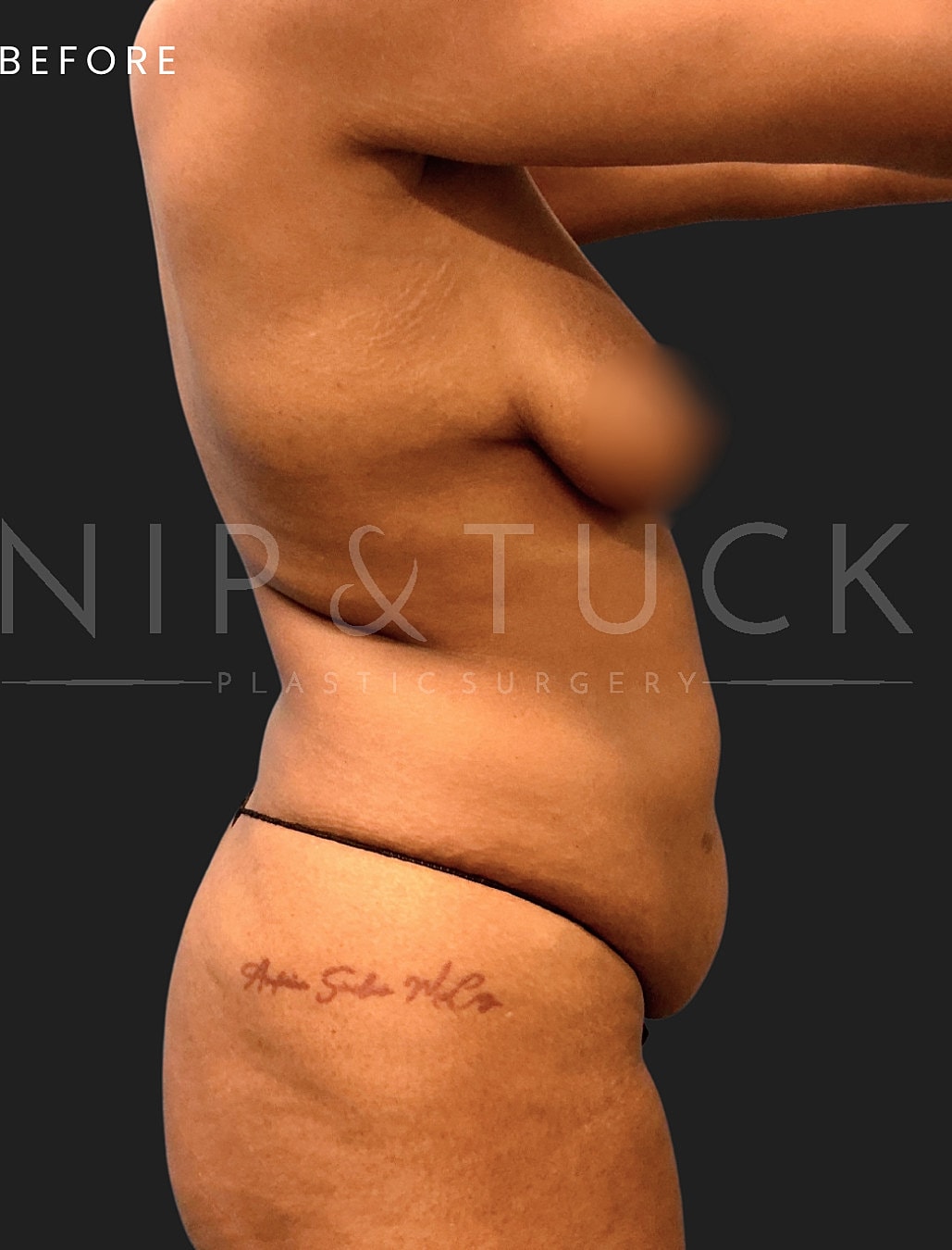 Abdominoplasty Before & After