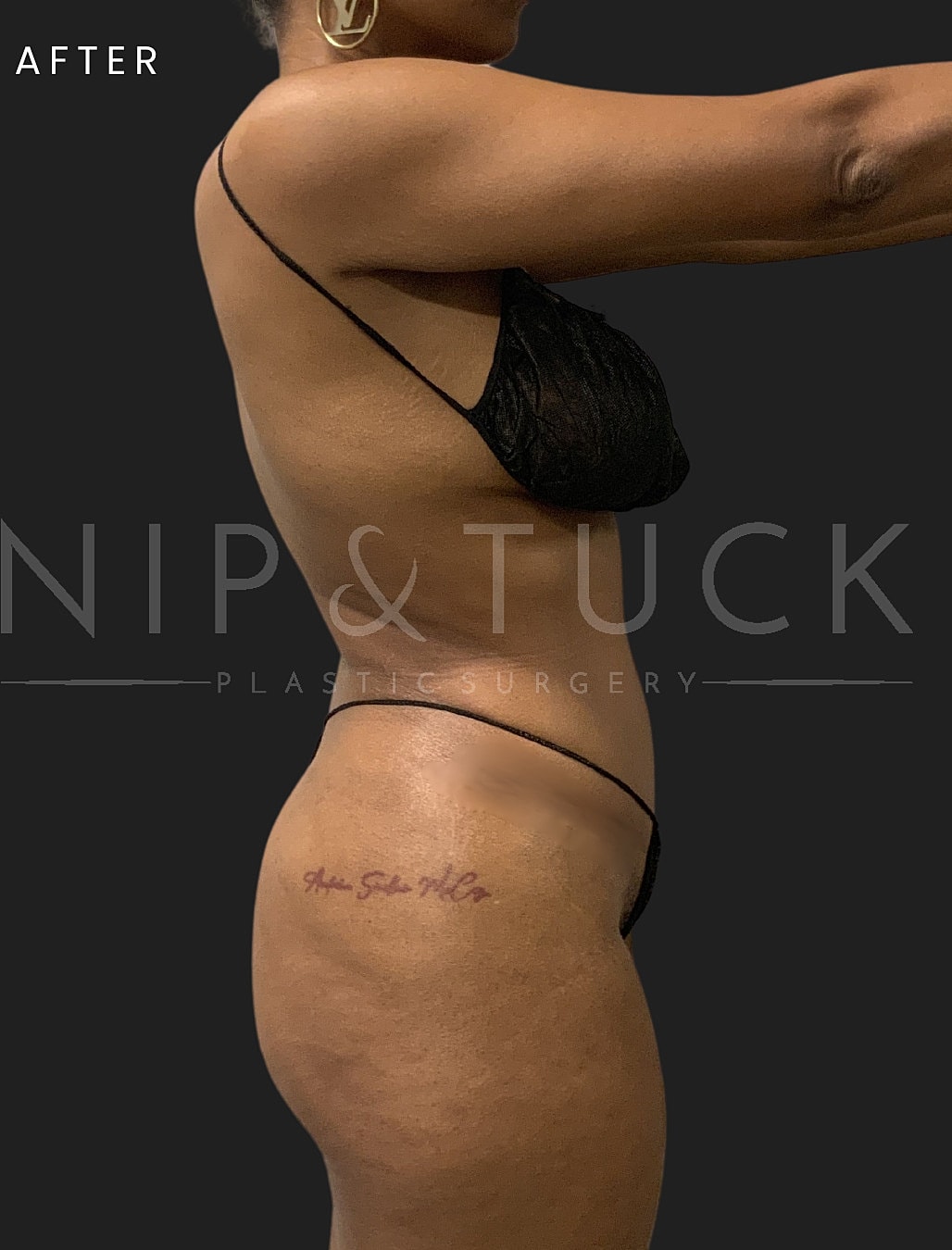 Abdominoplasty Before & After