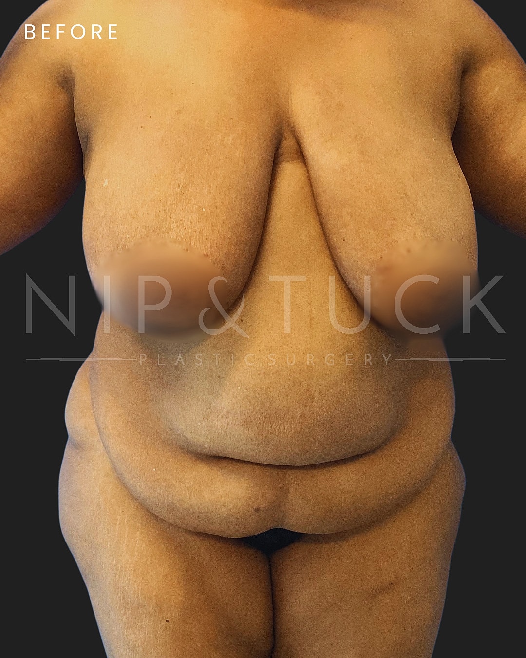 Abdominoplasty Before & After