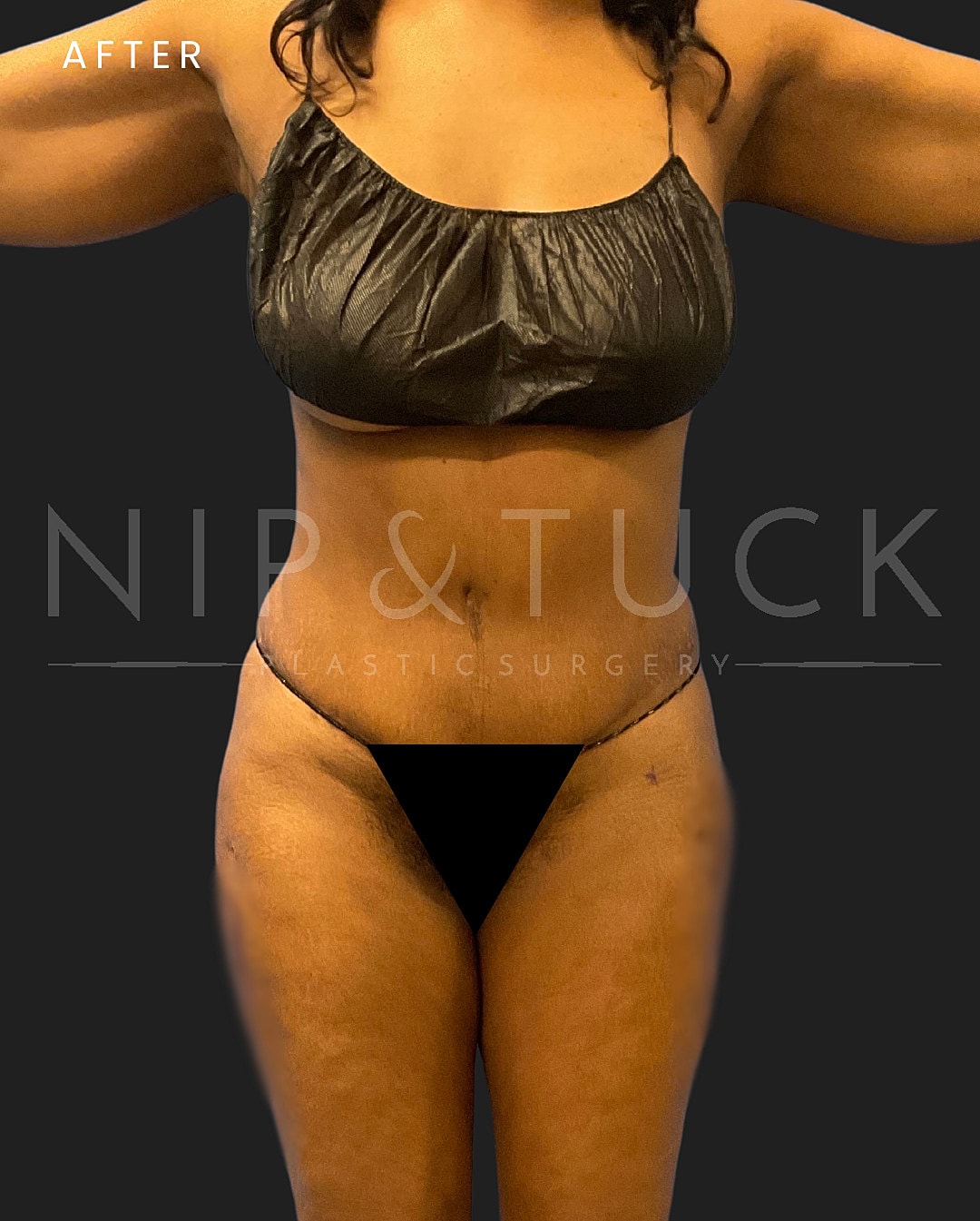 Abdominoplasty Before & After