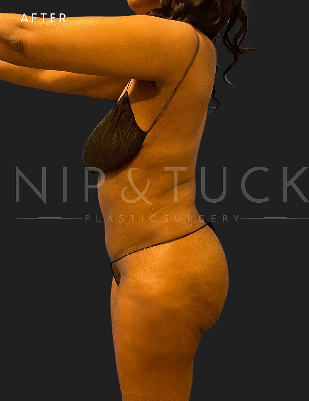 Abdominoplasty Before & After