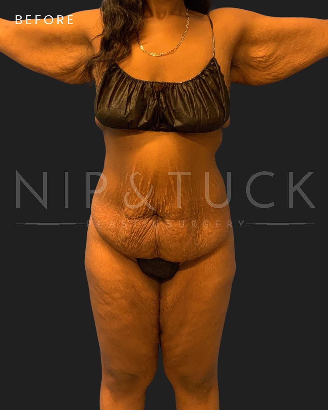 Abdominoplasty Before & After