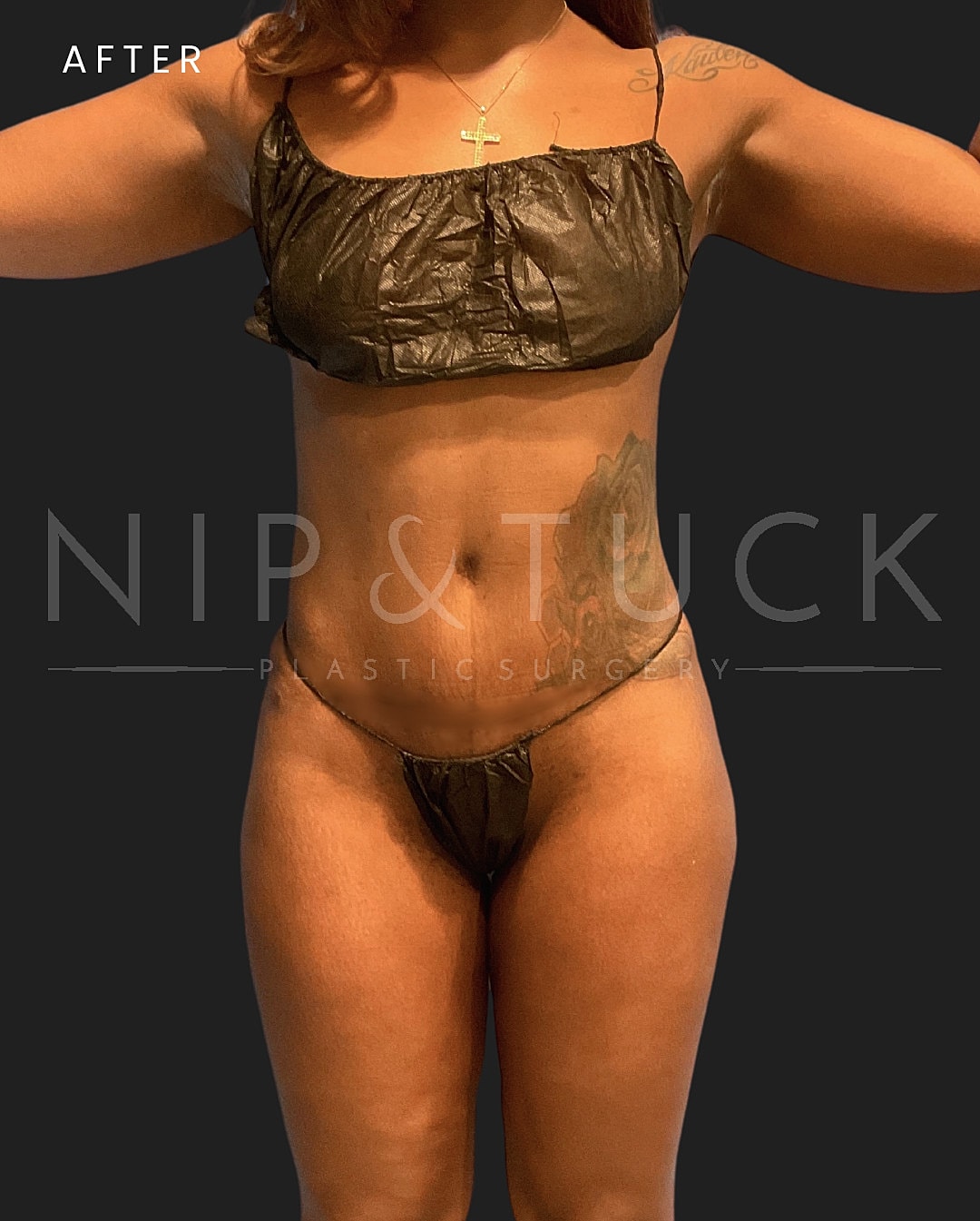Abdominoplasty Before & After