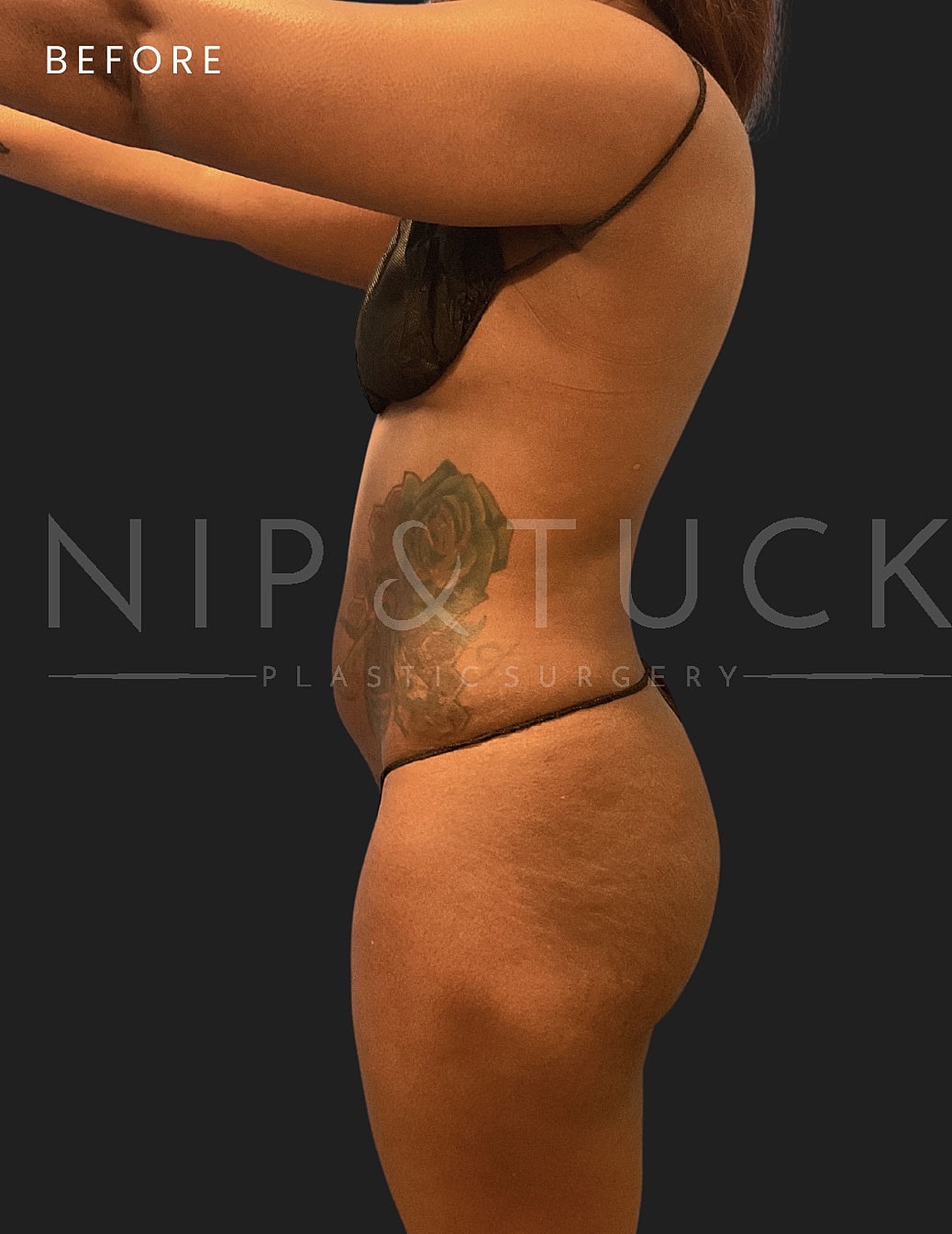 Abdominoplasty Before & After