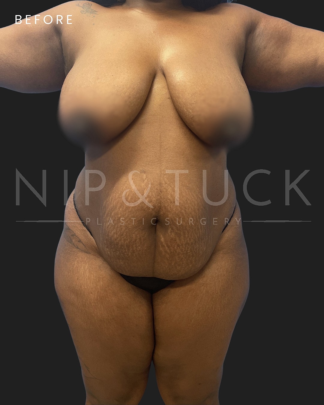 Abdominoplasty Before & After