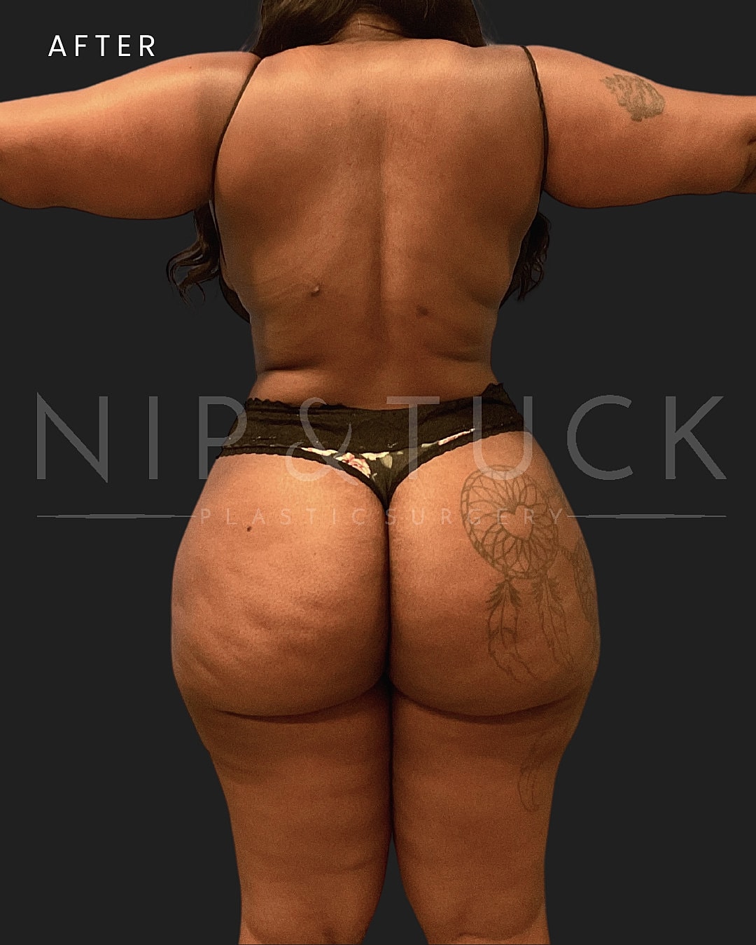 Abdominoplasty Before & After