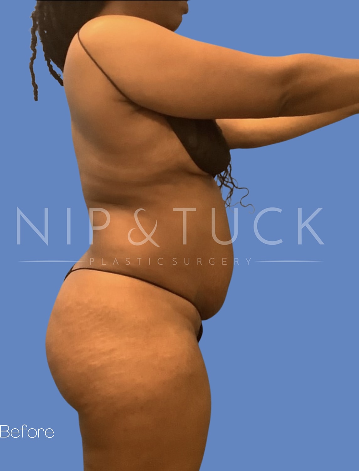 Abdominoplasty Before & After