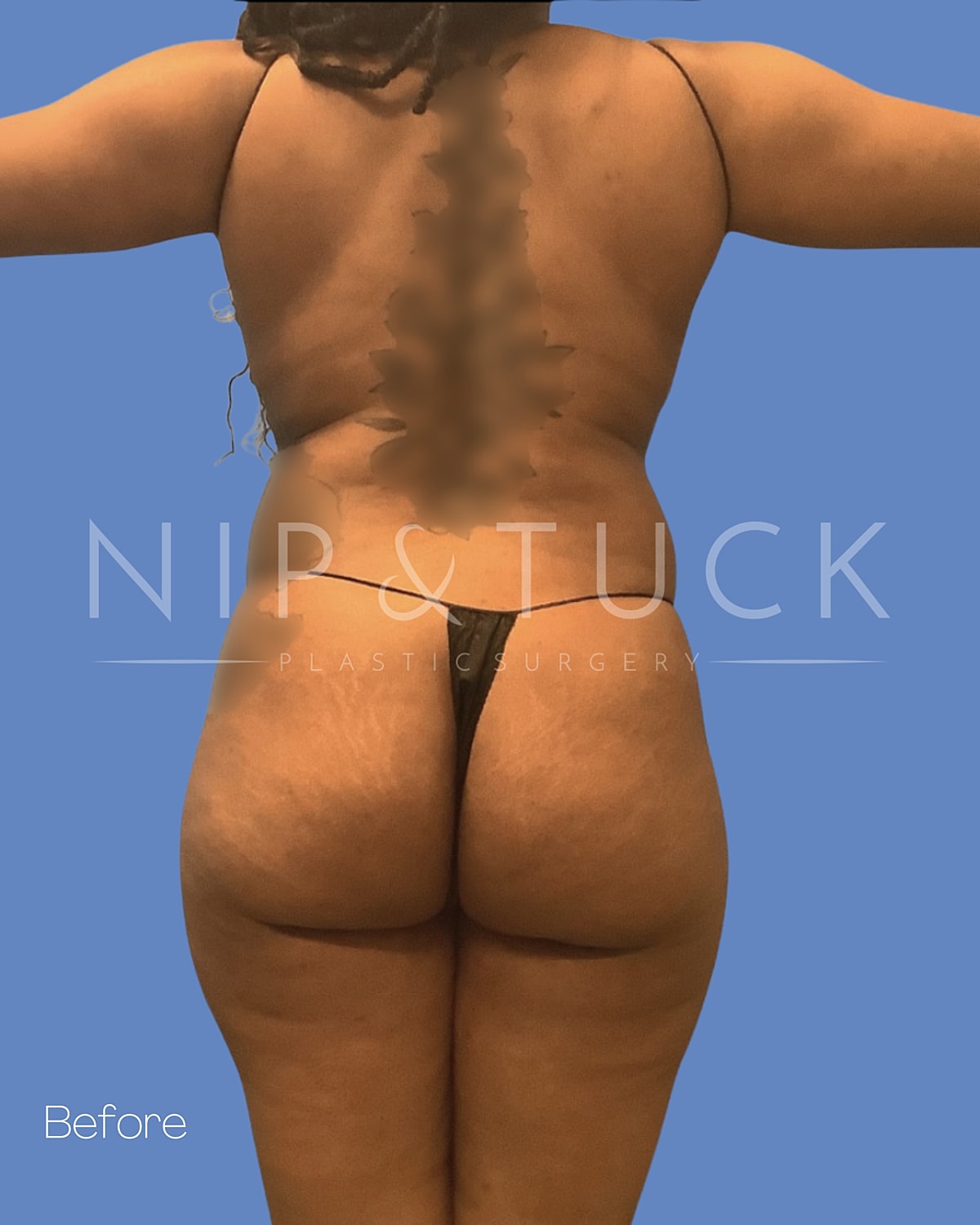 Abdominoplasty Before & After