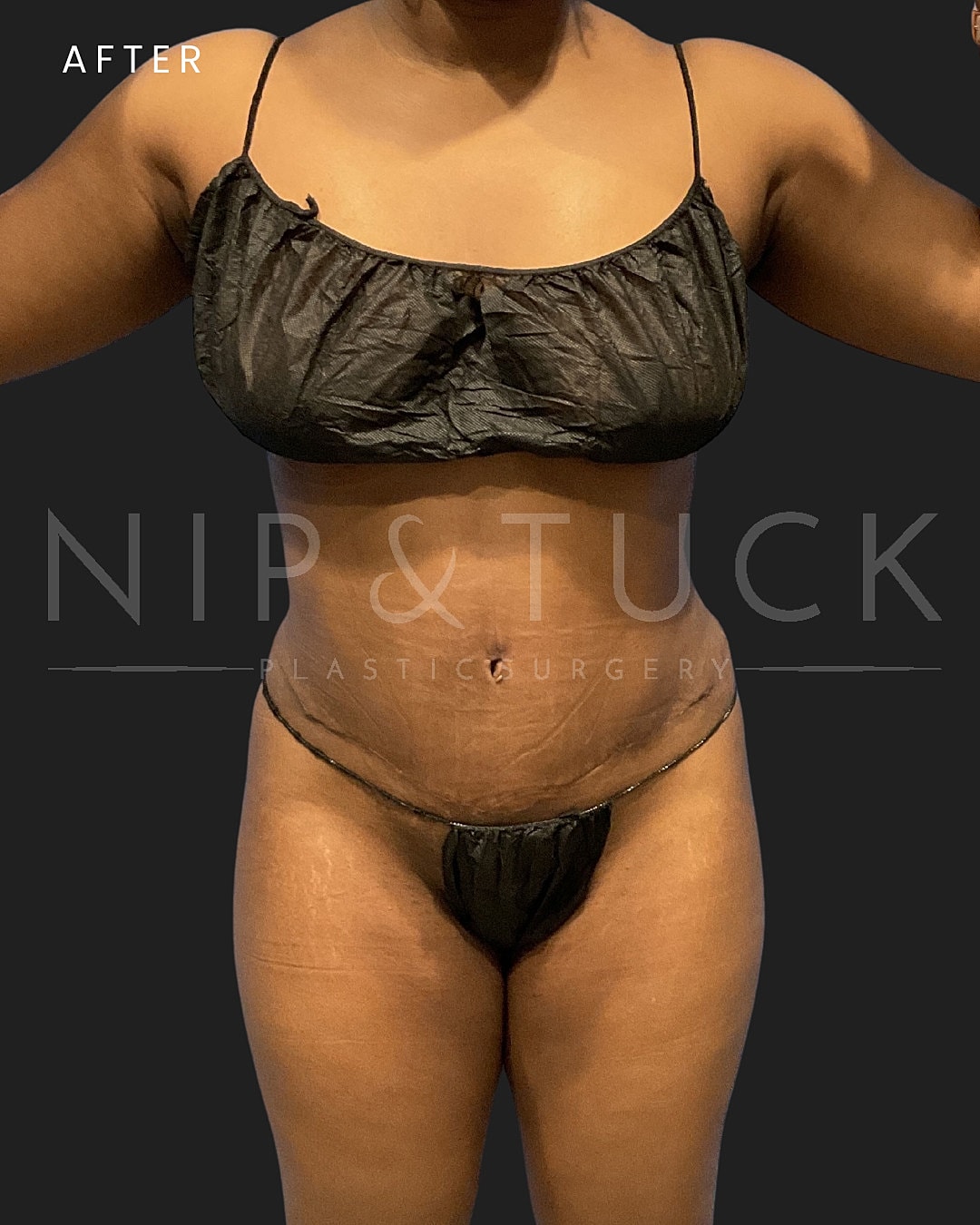 Abdominoplasty Before & After