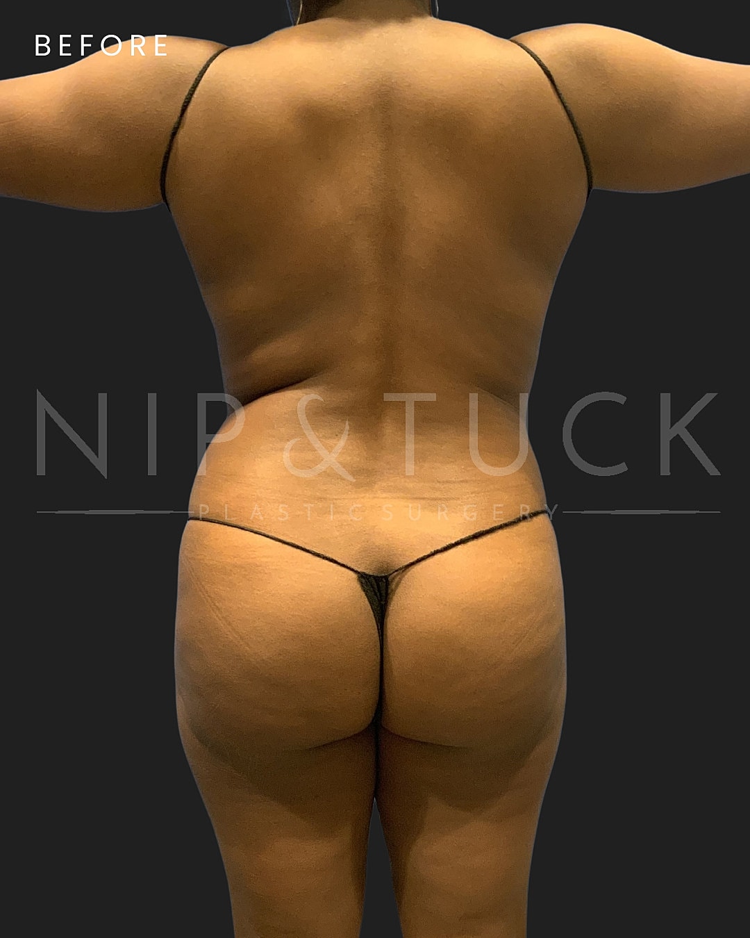 Abdominoplasty Before & After