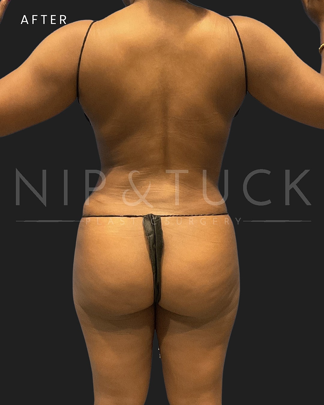Abdominoplasty Before & After