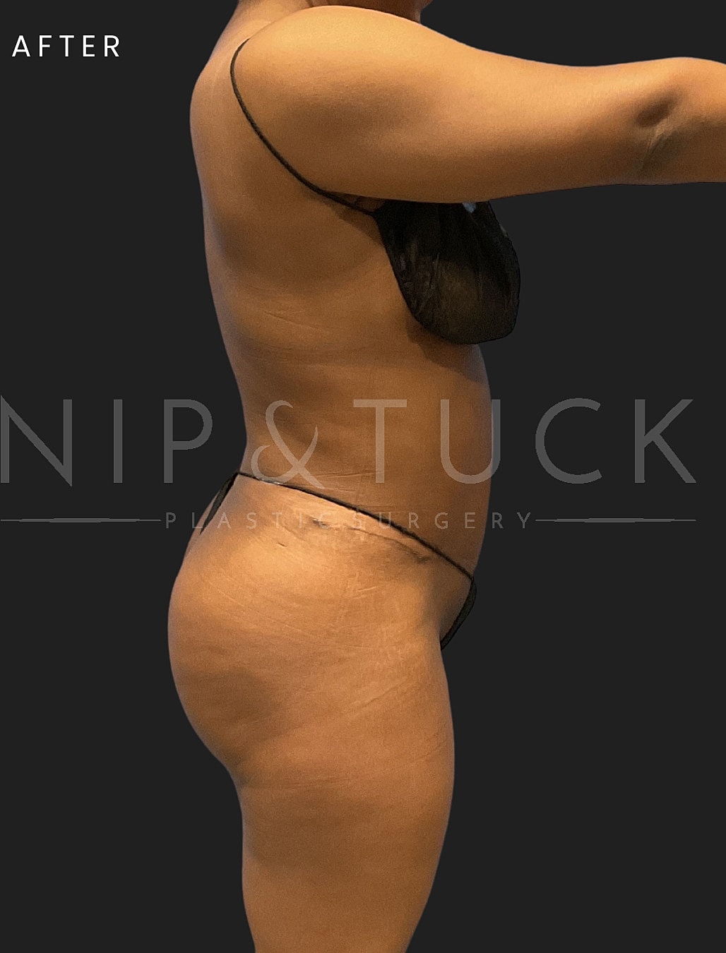 Abdominoplasty Before & After