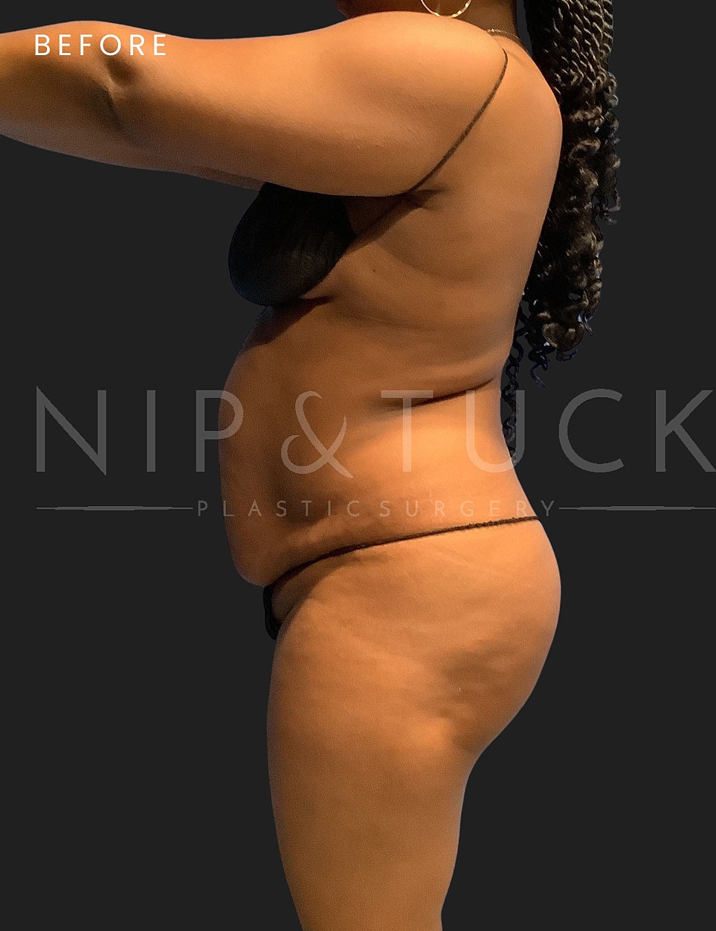 Abdominoplasty Before & After