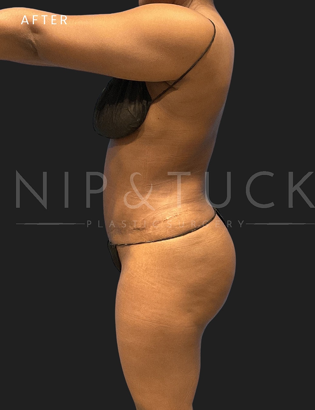 Abdominoplasty Before & After