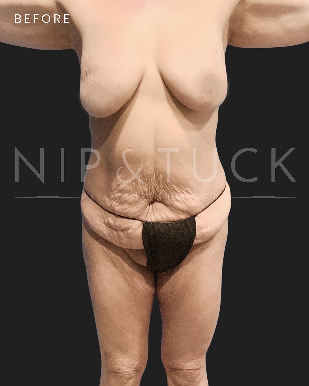 Abdominoplasty Before & After