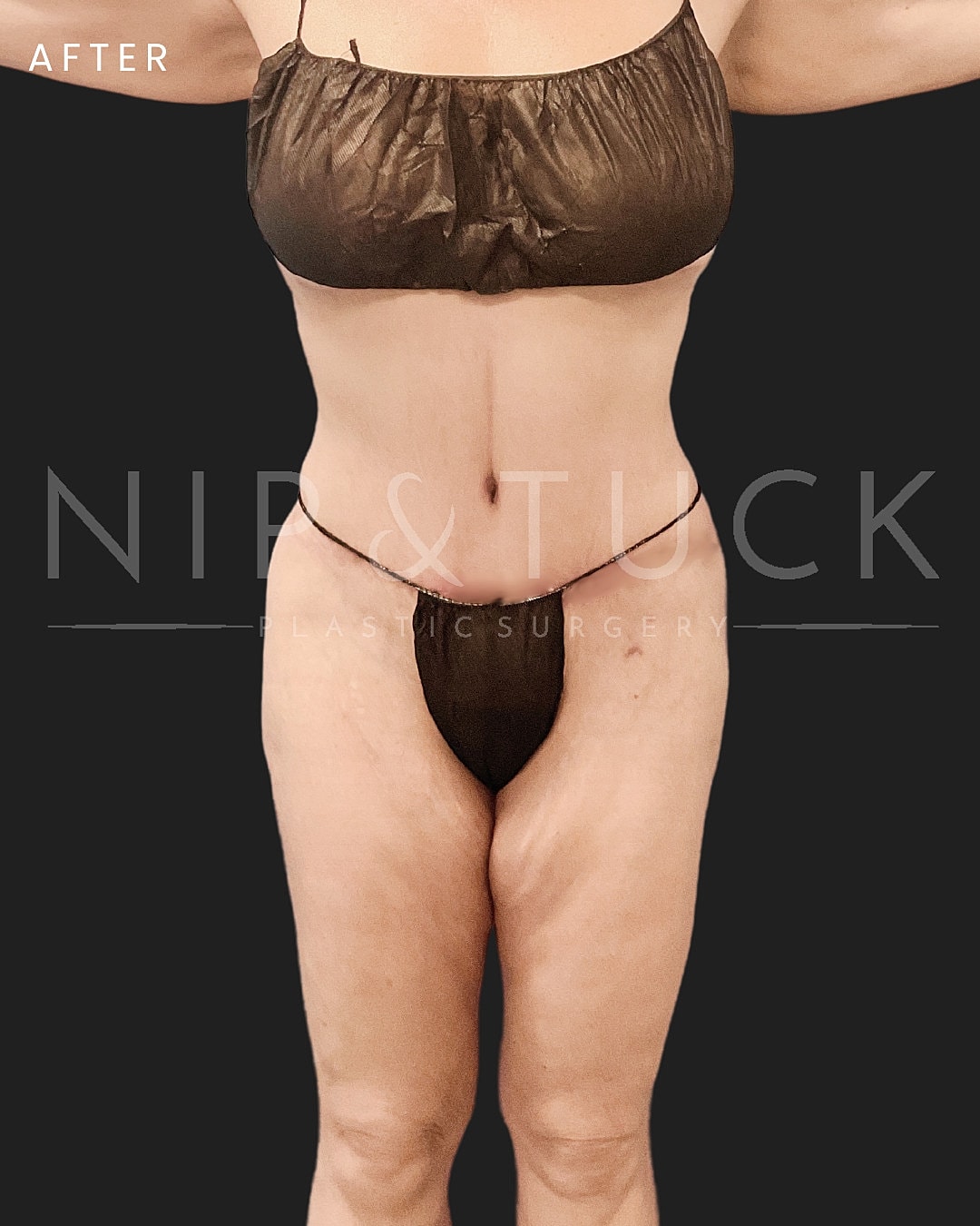 Abdominoplasty Before & After
