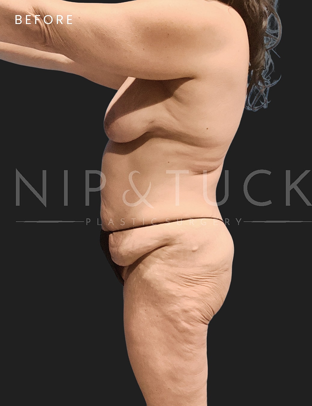 Abdominoplasty Before & After