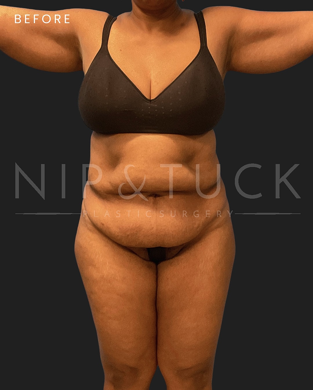 Abdominoplasty Before & After