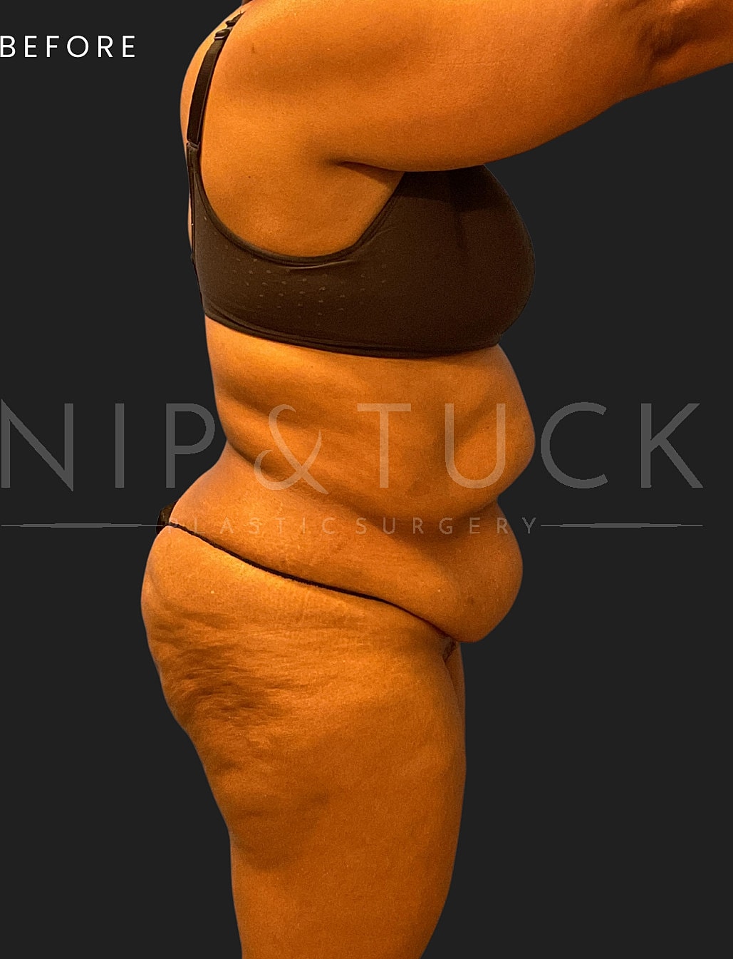 Abdominoplasty Before & After