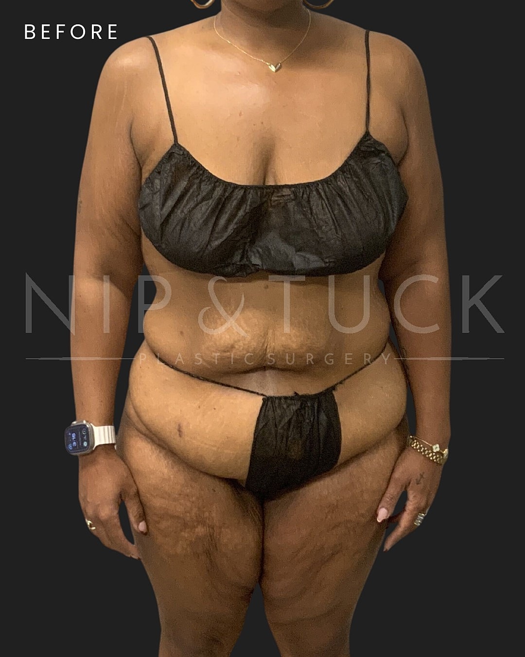 Abdominoplasty Before & After