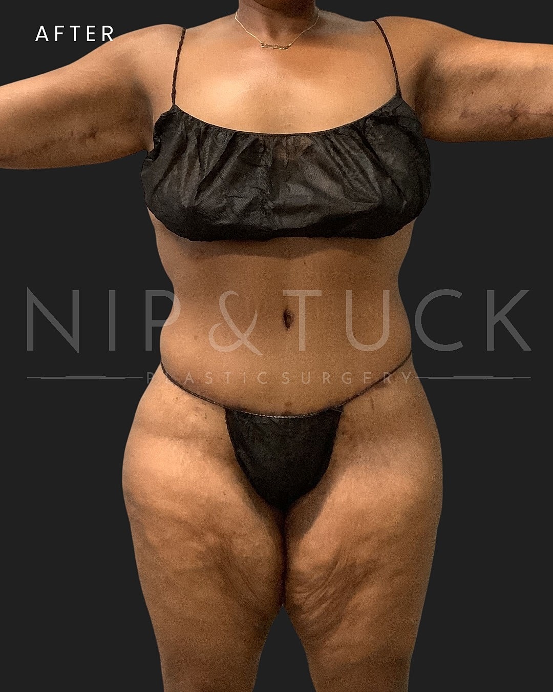Abdominoplasty Before & After