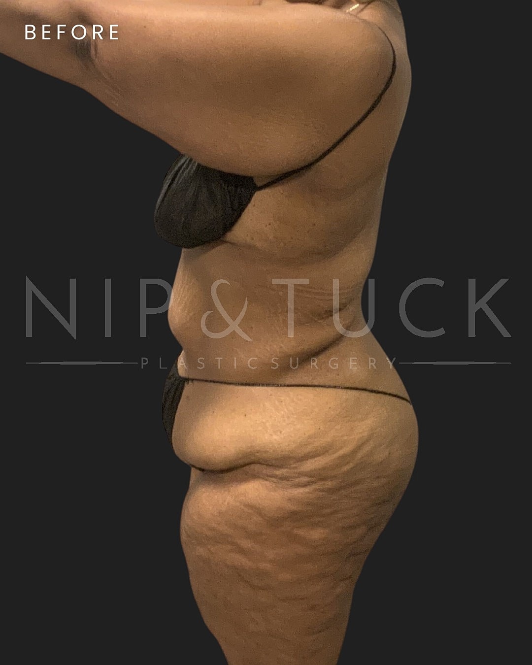 Abdominoplasty Before & After