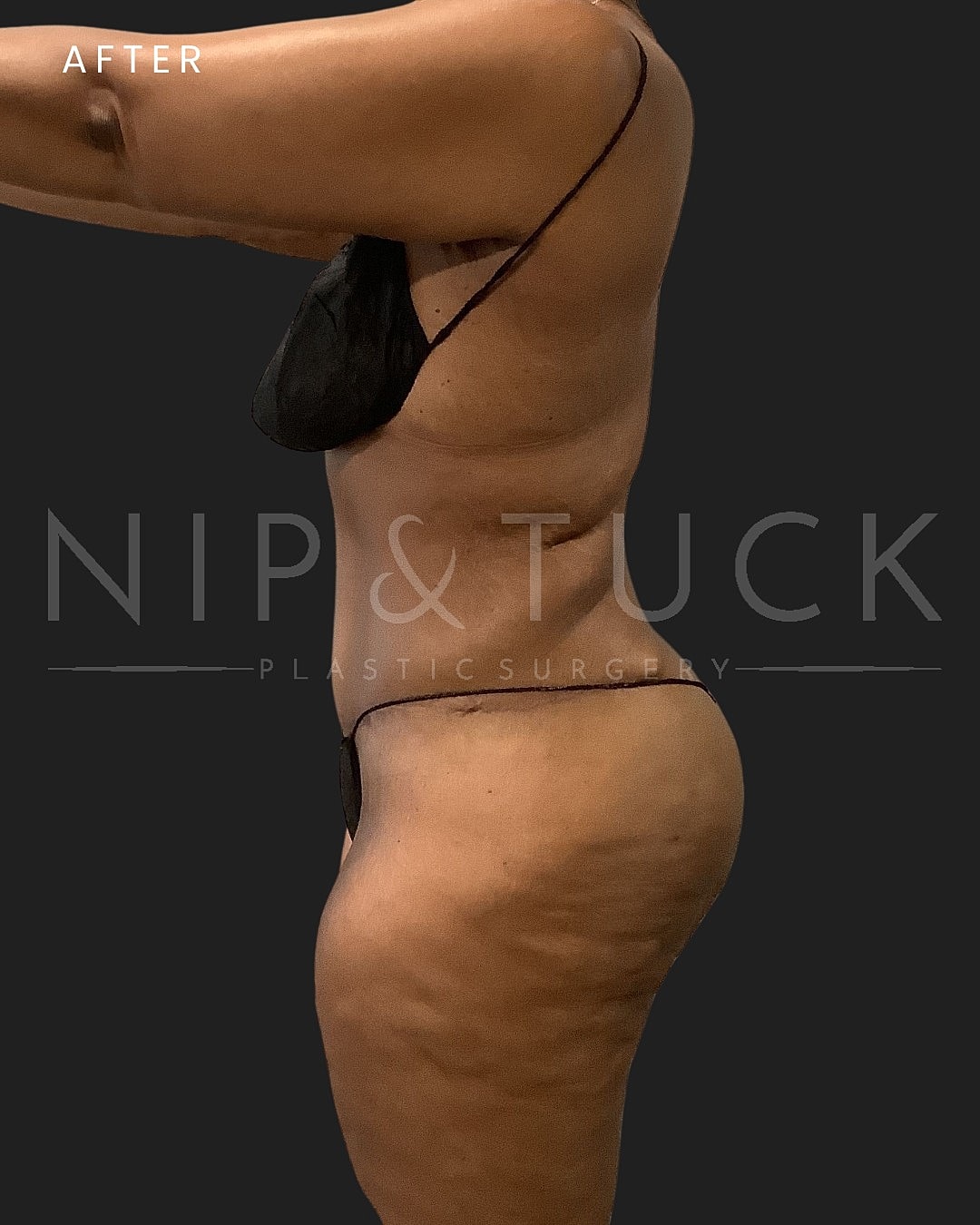 Abdominoplasty Before & After