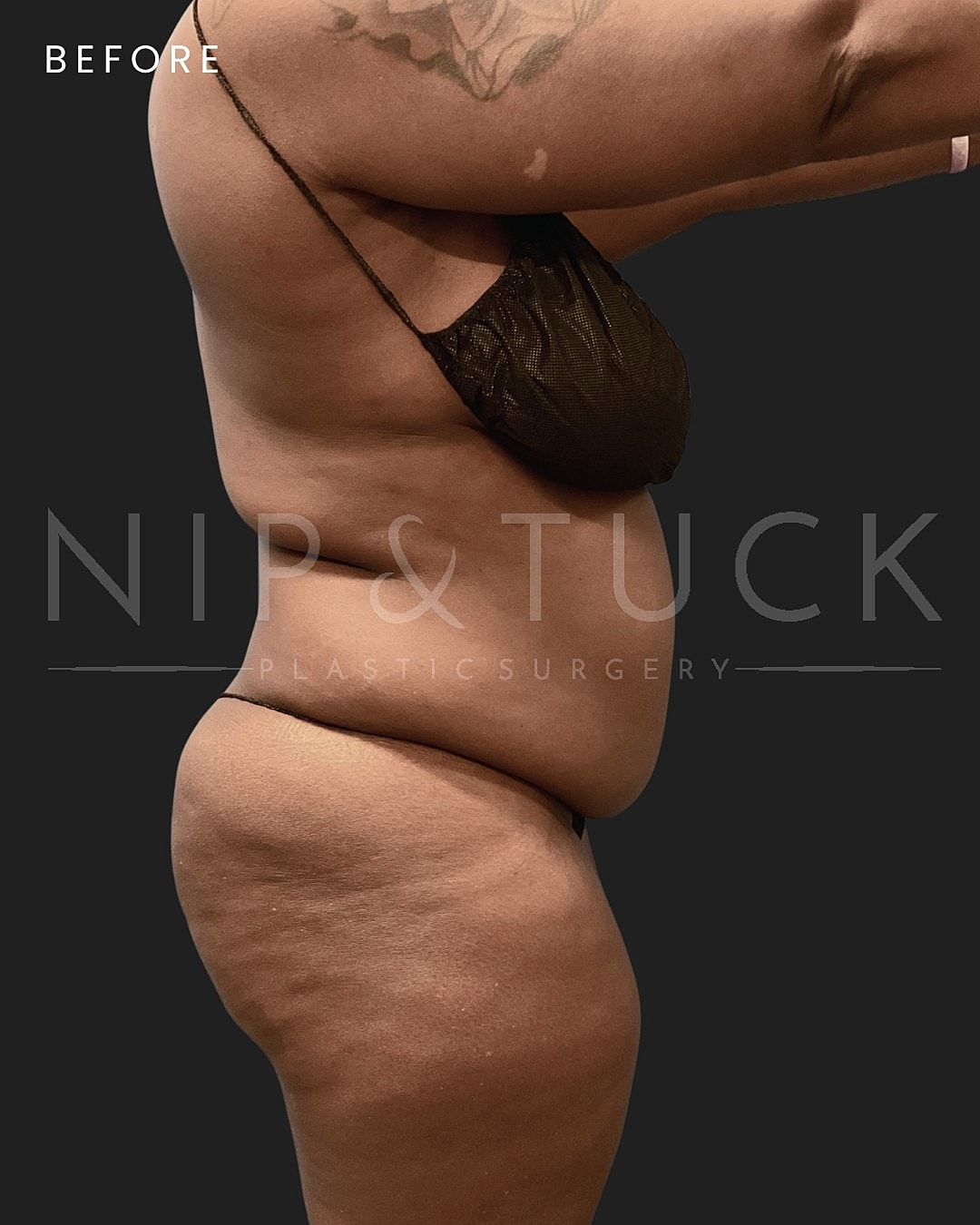 Abdominoplasty Before & After