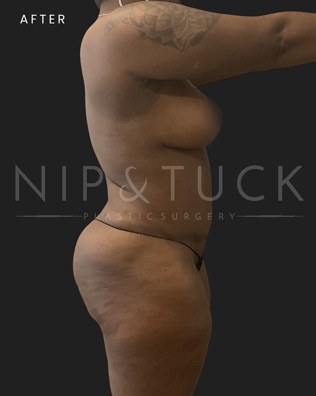 Abdominoplasty Before & After