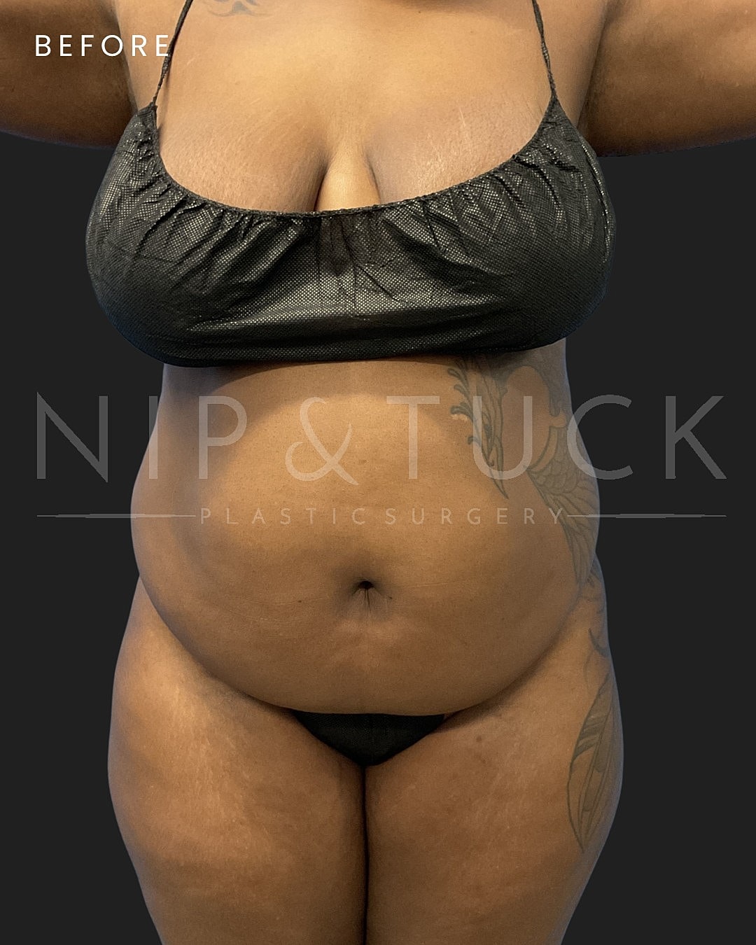 Abdominoplasty Before & After