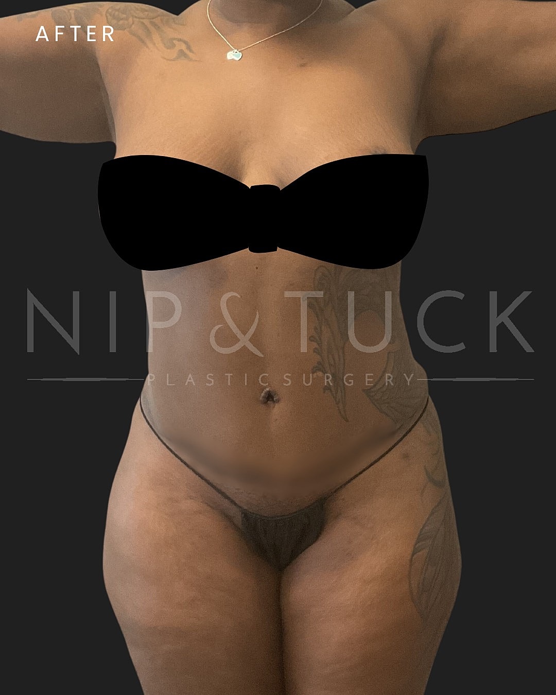 Abdominoplasty Before & After