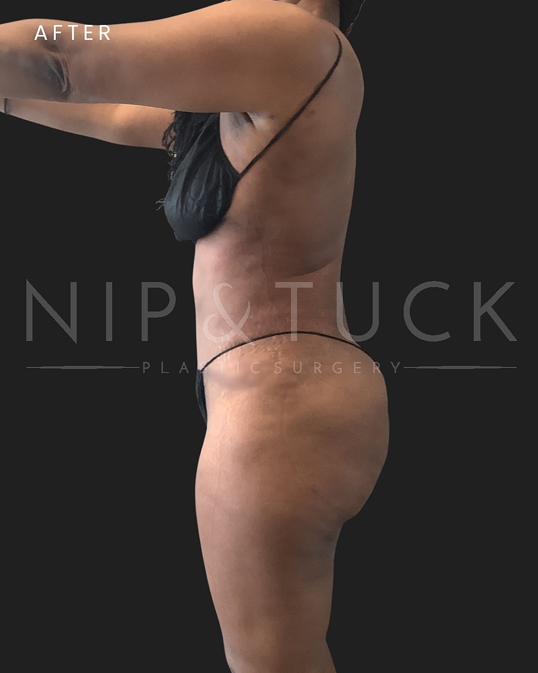 Abdominoplasty Before & After
