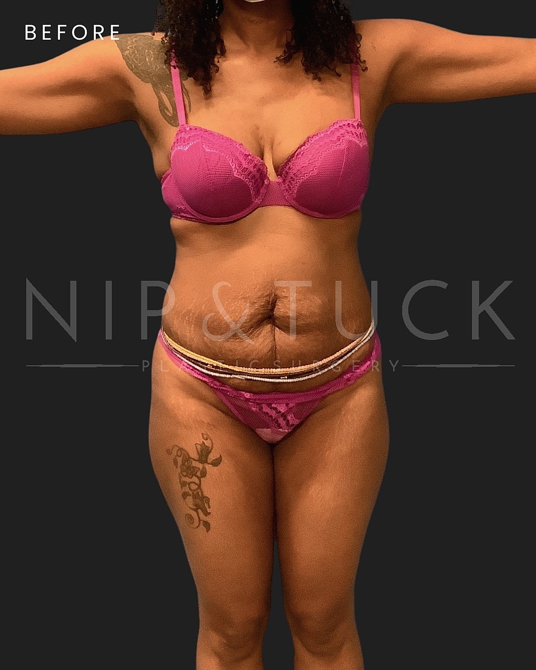 Abdominoplasty Before & After