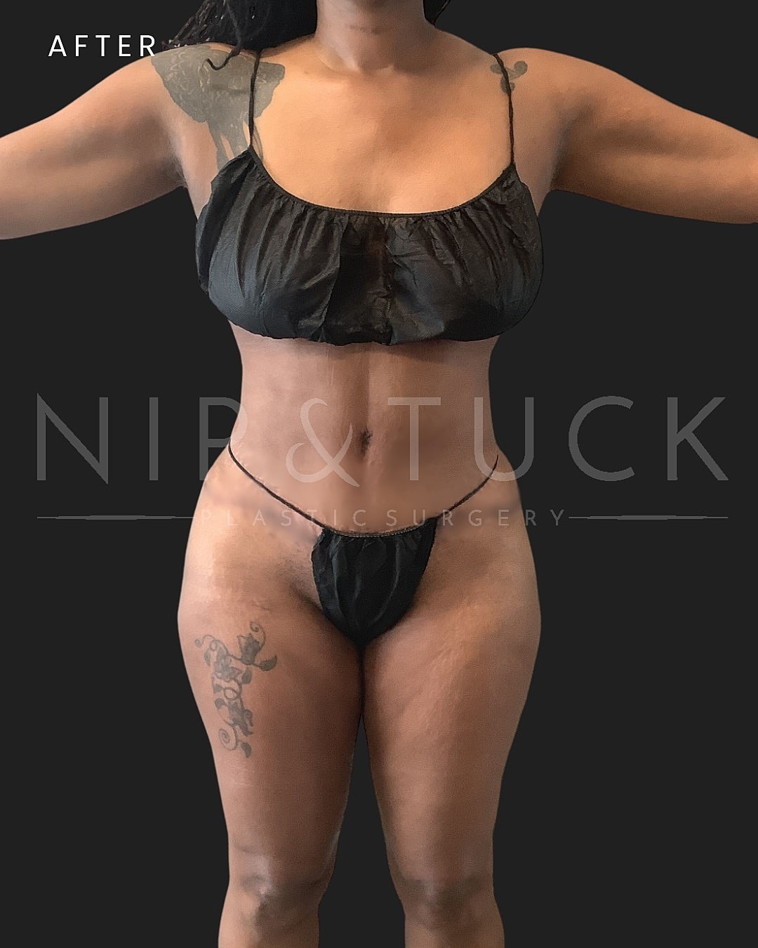 Abdominoplasty Before & After