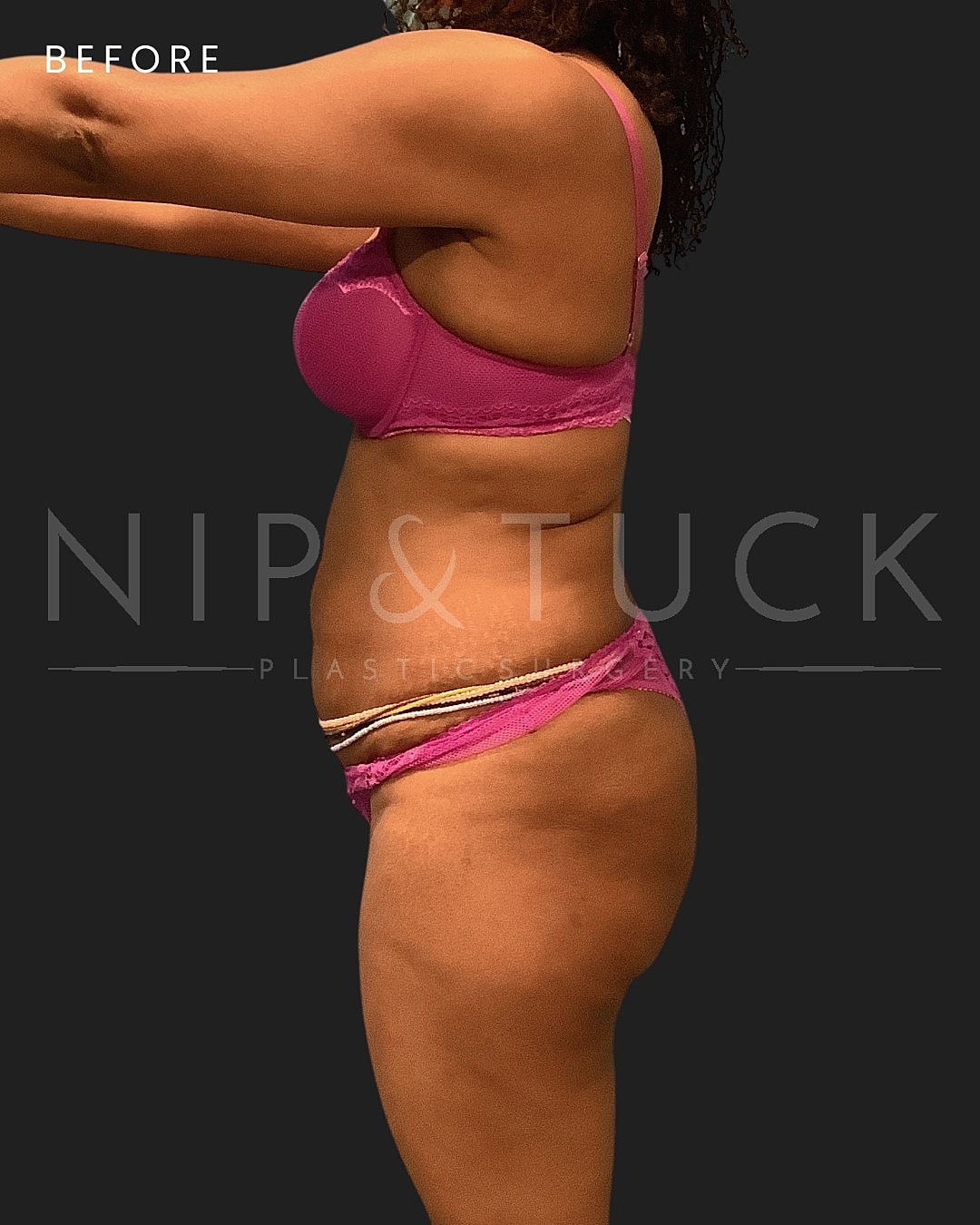 Abdominoplasty Before & After