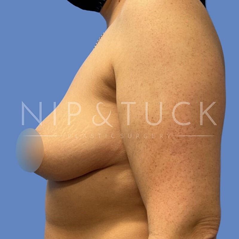 Breast Augmentation Before & After