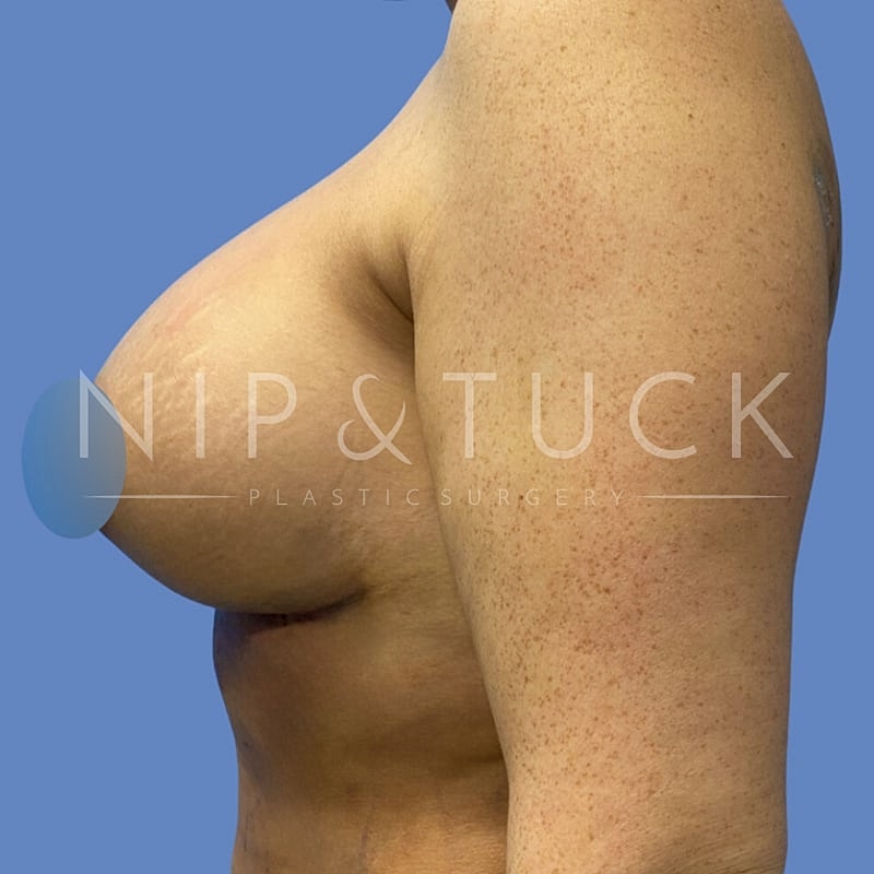 Breast Augmentation Before & After