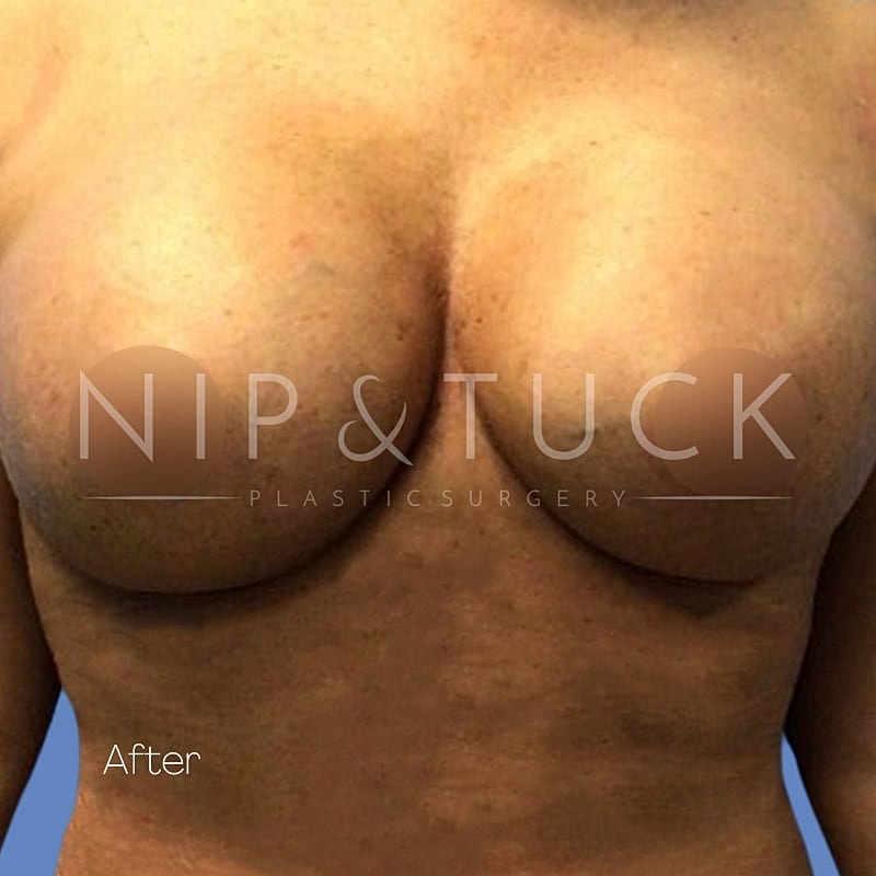 Breast Augmentation Before & After