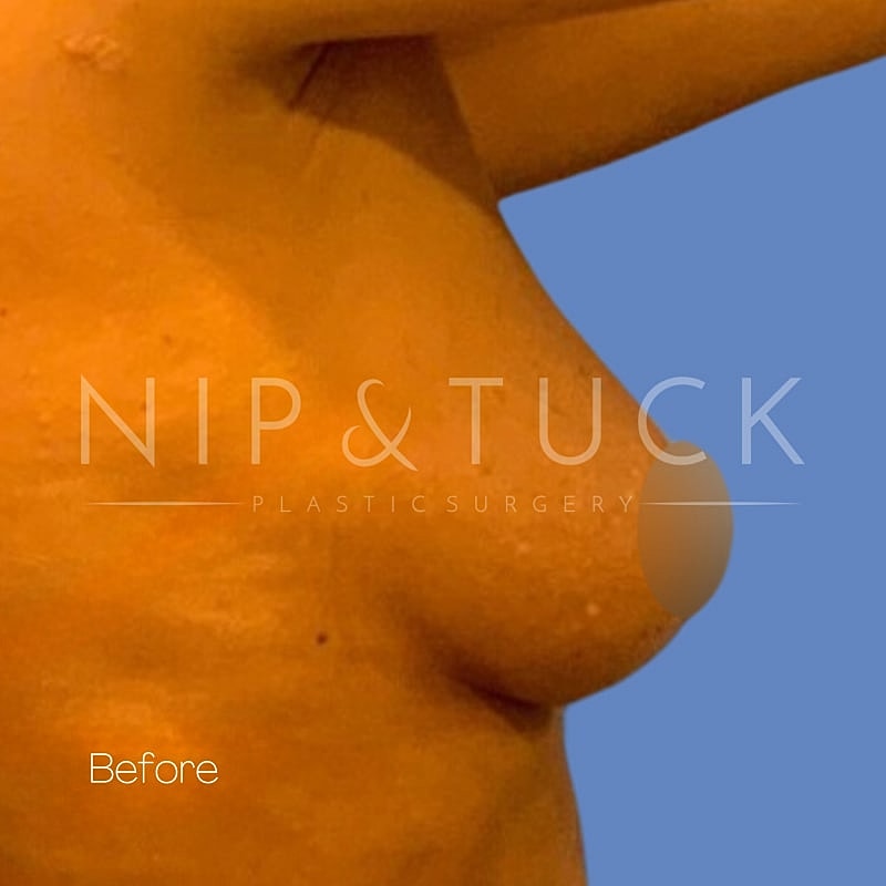 Breast Augmentation Before & After