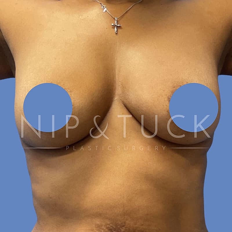 Breast Augmentation Before & After